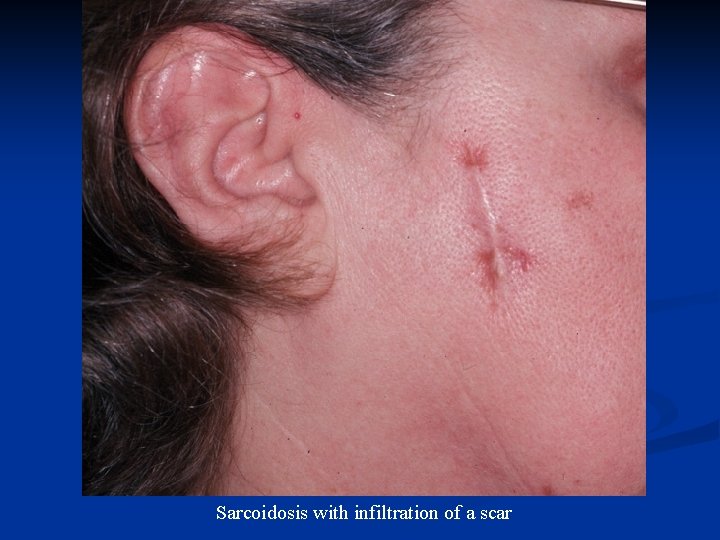 Sarcoidosis with infiltration of a scar 