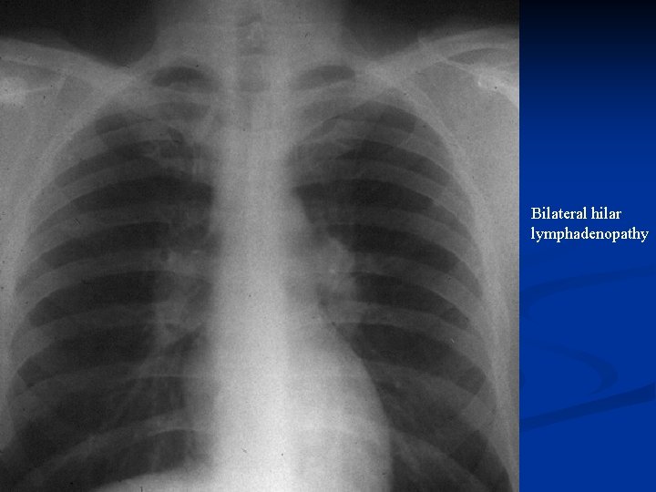 Bilateral hilar lymphadenopathy 