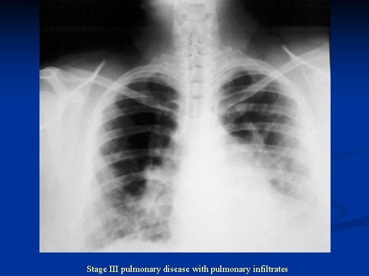 Stage III pulmonary disease with pulmonary infiltrates 