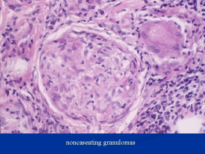 noncaseating granulomas 