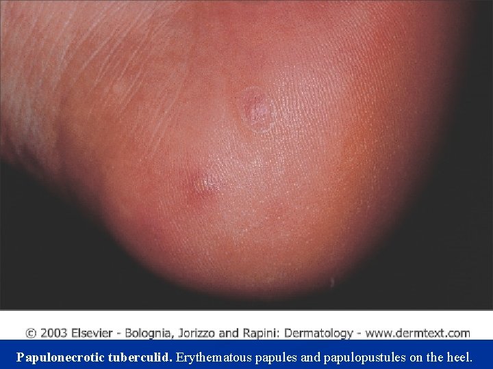 Papulonecrotic tuberculid. Erythematous papules and papulopustules on the heel. 