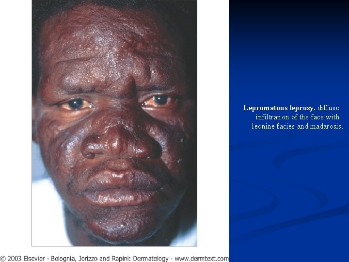 Lepromatous leprosy. diffuse infiltration of the face with leonine facies and madarosis. 