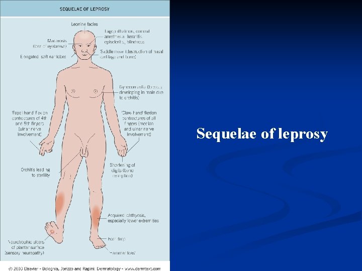 Sequelae of leprosy 