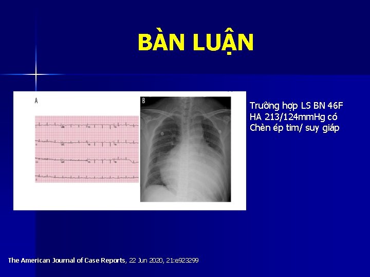 BÀN LUẬN Trường hợp LS BN 46 F HA 213/124 mm. Hg có Chèn