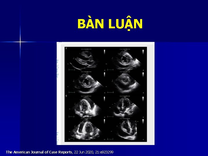 BÀN LUẬN The American Journal of Case Reports, 22 Jun 2020, 21: e 923299