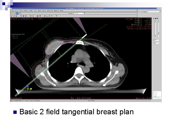 TWO FIELD BREAST PLAN VS OPTIMIZED CONFORMAL BREAST two-field-breast-plan-vs-optimized-conformal-breast