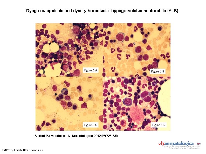 Dysgranulopoiesis and dyserythropoiesis: hypogranulated neutrophils (A–B). Stefani Parmentier et al. Haematologica 2012; 97: 723