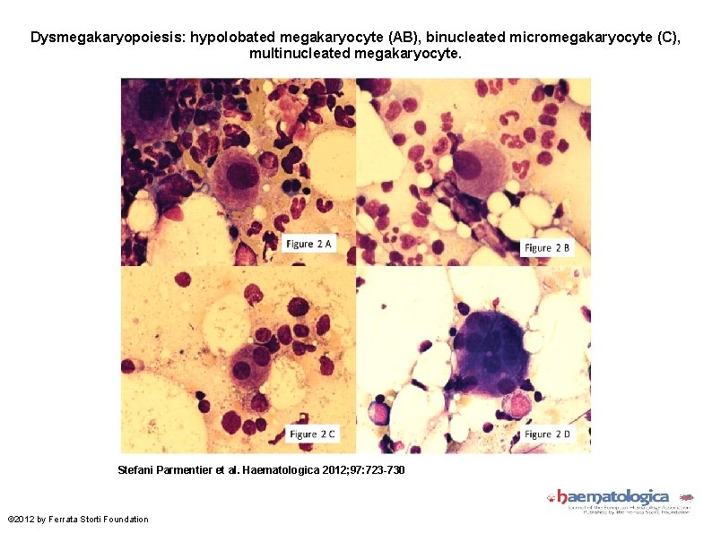 Dysmegakaryopoiesis: hypolobated megakaryocyte (AB), binucleated micromegakaryocyte (C), multinucleated megakaryocyte. Stefani Parmentier et al. Haematologica