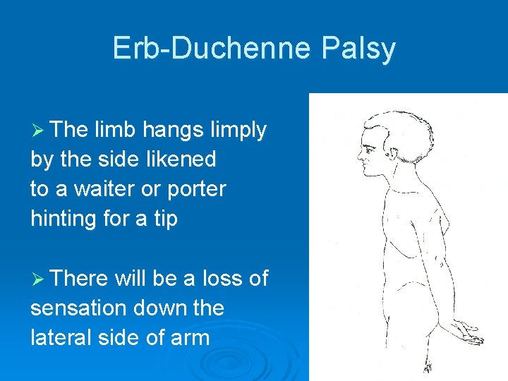 Erb-Duchenne Palsy Ø The limb hangs limply by the side likened to a waiter