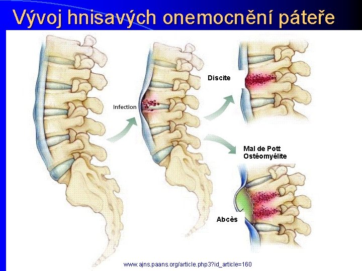 Vývoj hnisavých onemocnění páteře www. ajns. paans. org/article. php 3? id_article=160 