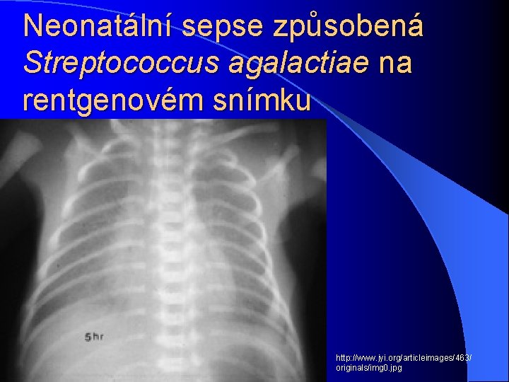 Neonatální sepse způsobená Streptococcus agalactiae na rentgenovém snímku http: //www. jyi. org/articleimages/463/ originals/img 0.