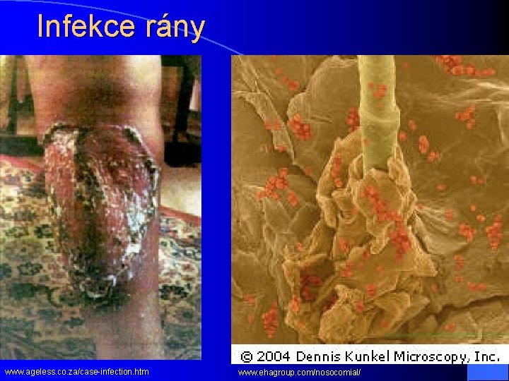 Infekce rány www. ageless. co. za/case-infection. htm www. ehagroup. com/nosocomial/ 