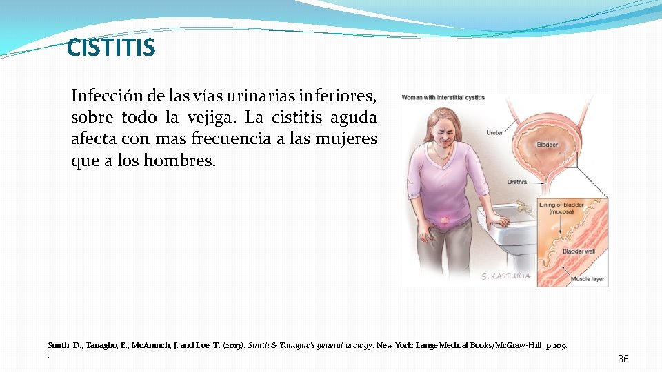 CISTITIS Infección de las vías urinarias inferiores, sobre todo la vejiga. La cistitis aguda