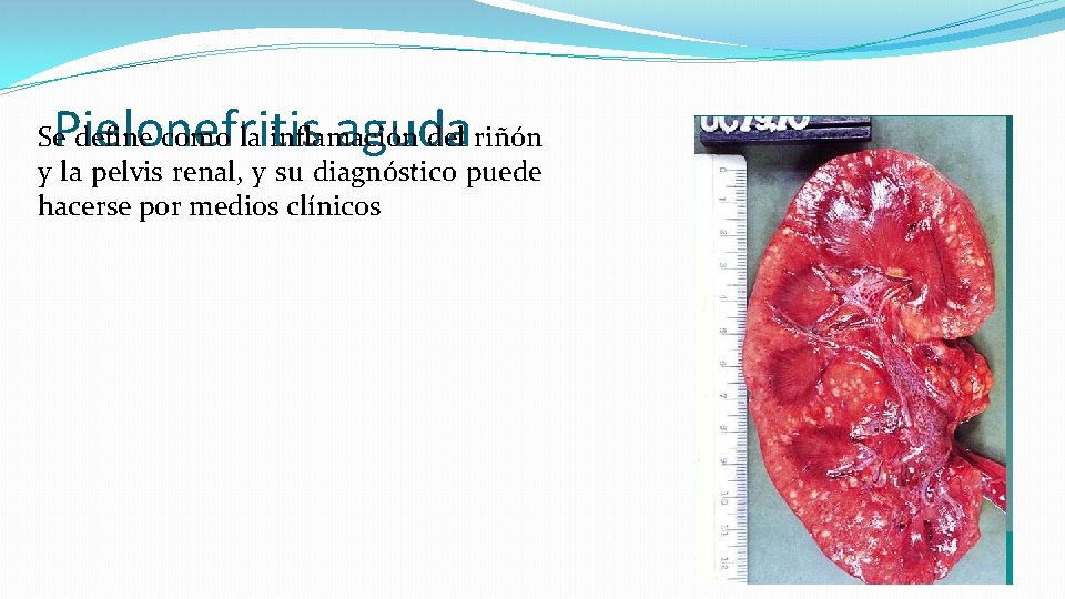 Pielonefritis aguda Se define como la inflamación del riñón y la pelvis renal, y