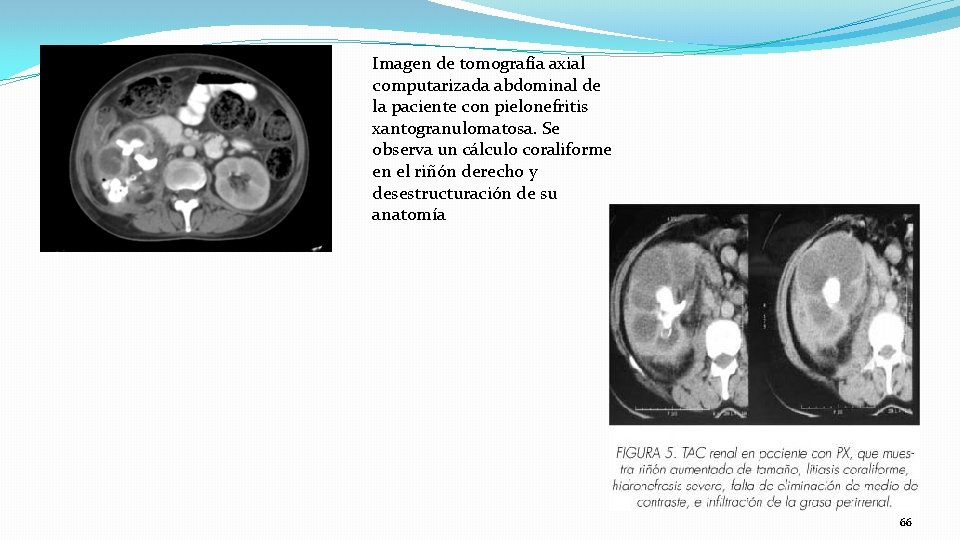 Imagen de tomografía axial computarizada abdominal de la paciente con pielonefritis xantogranulomatosa. Se observa