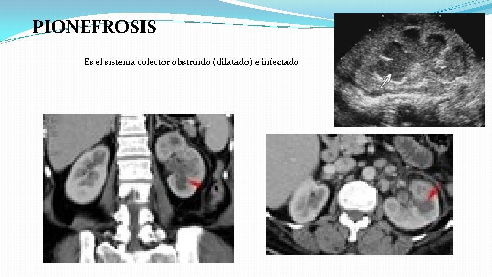 PIONEFROSIS Es el sistema colector obstruido (dilatado) e infectado 