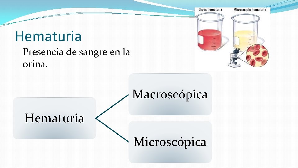 Hematuria Presencia de sangre en la orina. Macroscópica Hematuria Microscópica 