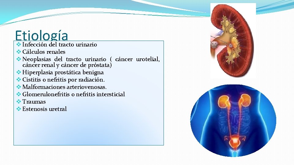 Etiología v Infección del tracto urinario v Cálculos renales v Neoplasias del tracto urinario