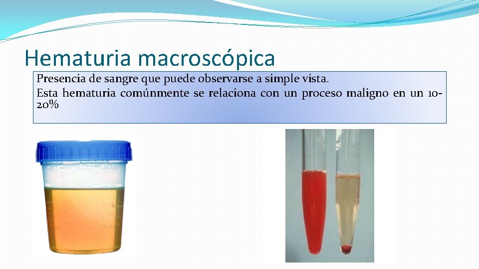Hematuria macroscópica Presencia de sangre que puede observarse a simple vista. Esta hematuria comúnmente