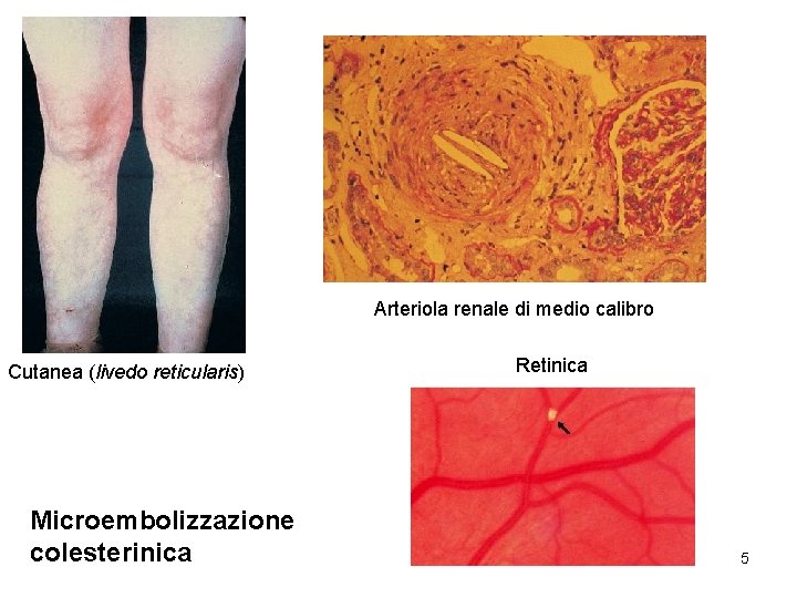 Arteriola renale di medio calibro Cutanea (livedo reticularis) Microembolizzazione colesterinica Retinica 5 