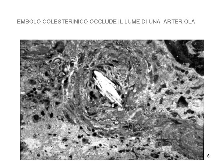 EMBOLO COLESTERINICO OCCLUDE IL LUME DI UNA ARTERIOLA 6 