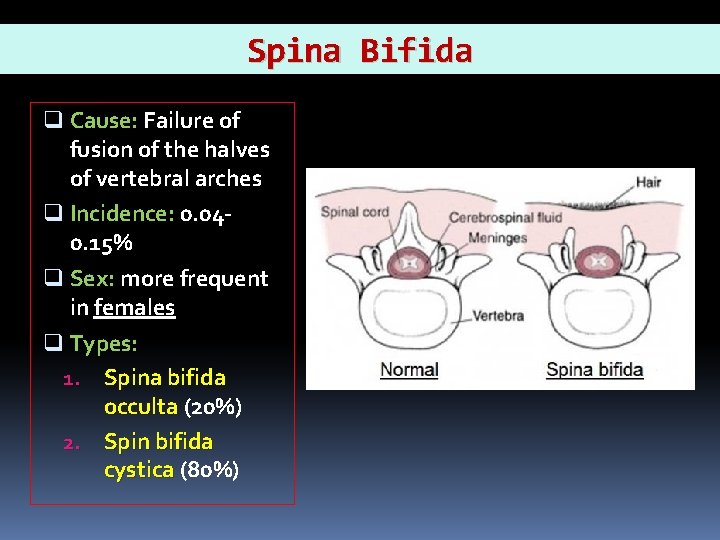 Spina Bifida q Cause: Failure of fusion of the halves of vertebral arches q