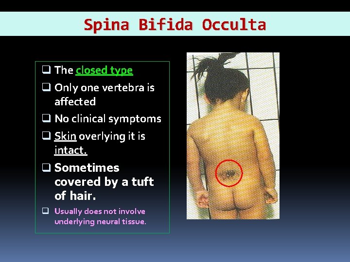 Spina Bifida Occulta q The closed type q Only one vertebra is affected q
