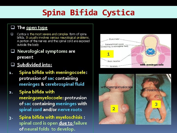 Spina Bifida Cystica q The open type q Cystica is the most severe and