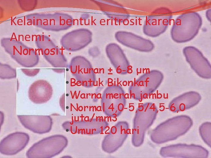 Kelainan bentuk eritrosit karena Anemi : Normosit : • Ukuran ± 6 -8 μm