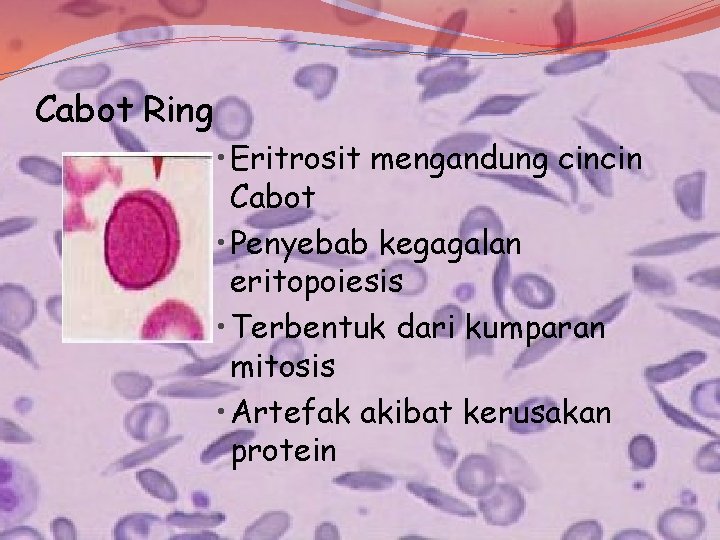 Cabot Ring • Eritrosit mengandung cincin Cabot • Penyebab kegagalan eritopoiesis • Terbentuk dari