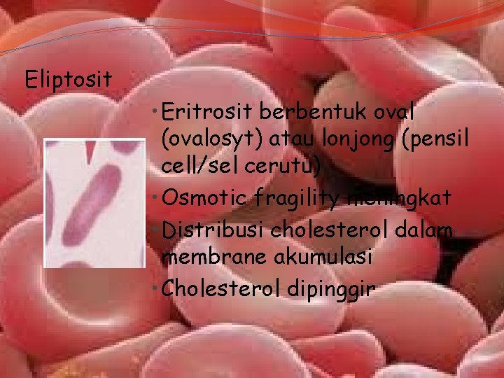 Eliptosit • Eritrosit berbentuk oval (ovalosyt) atau lonjong (pensil cell/sel cerutu) • Osmotic fragility