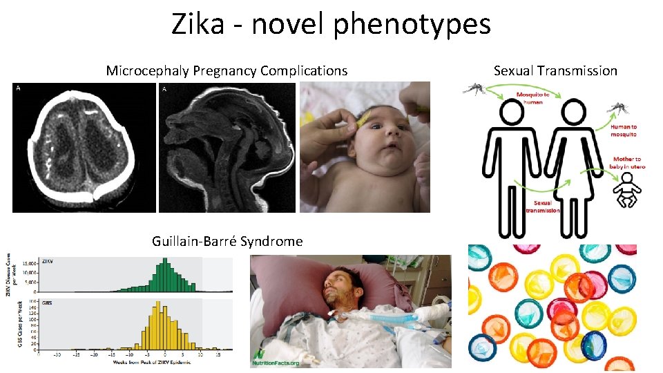 Zika - novel phenotypes Microcephaly Pregnancy Complications Guillain-Barré Syndrome Sexual Transmission 
