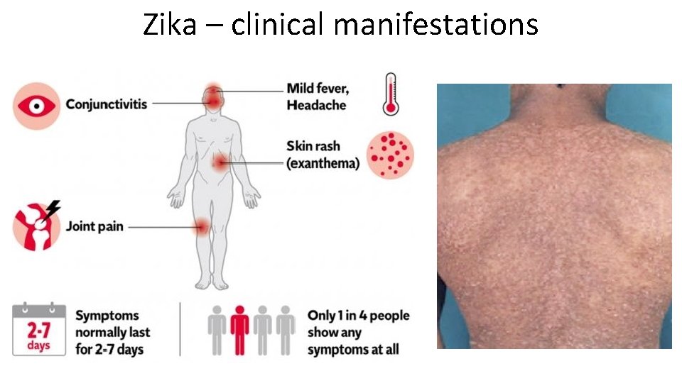 Zika – clinical manifestations 