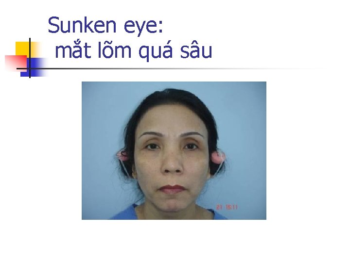 Sunken eye: mắt lõm quá sâu 