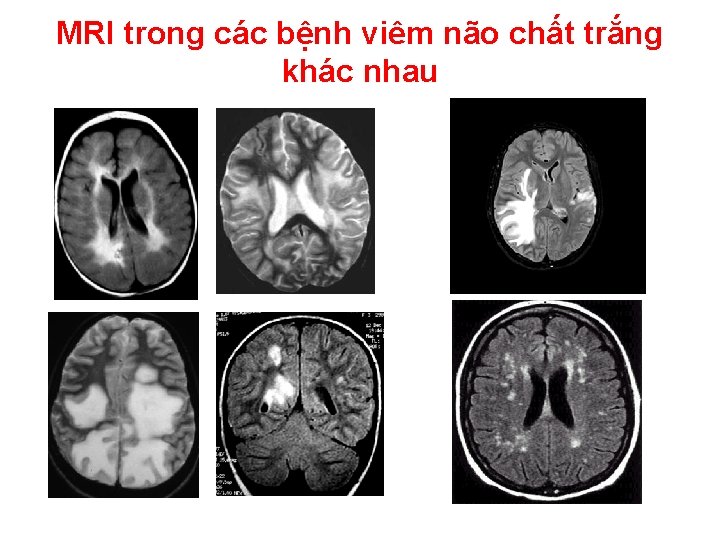 MRI trong các bệnh viêm não chất trắng khác nhau 