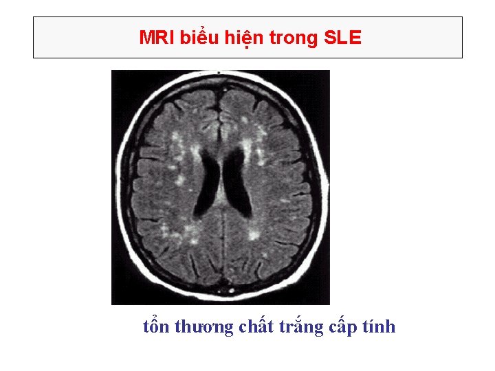 MRI biểu hiện trong SLE tổn thương chất trắng cấp tính 