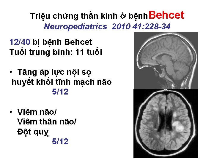 Triệu chứng thần kinh ở bệnh. Behcet Neuropediatrics 2010 41: 228 -34 12/40 bị