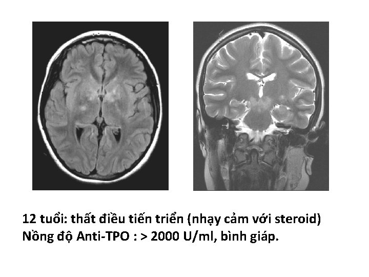 12 tuổi: thất điều tiến triển (nhạy cảm với steroid) Nồng độ Anti-TPO :