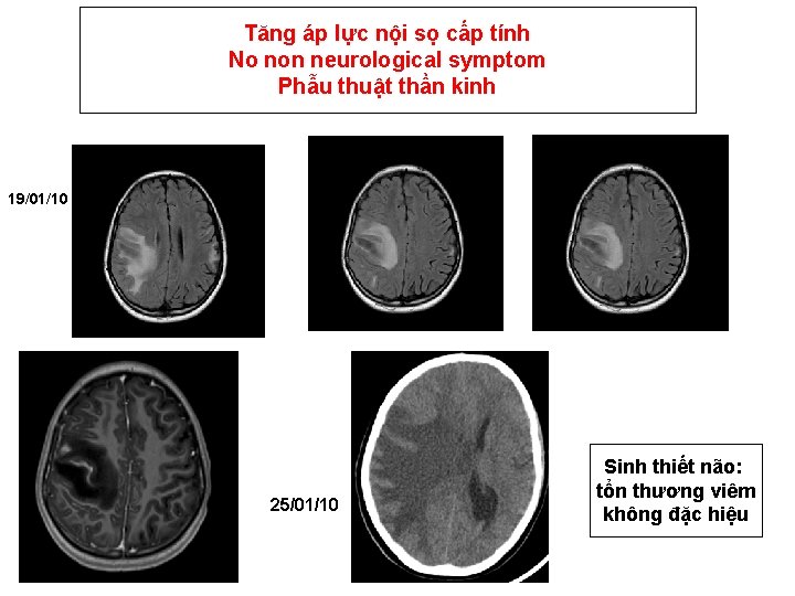 Tăng áp lực nội sọ cấp tính No non neurological symptom Phẫu thuật thần