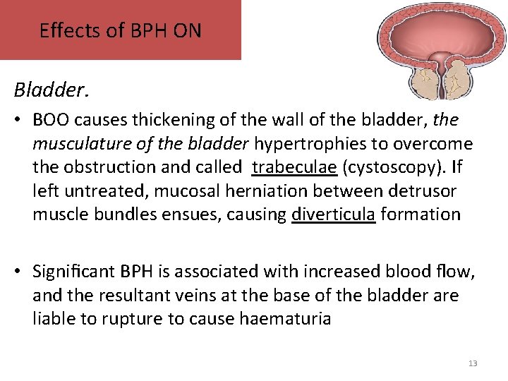 Effects of BPH ON Bladder. • BOO causes thickening of the wall of the