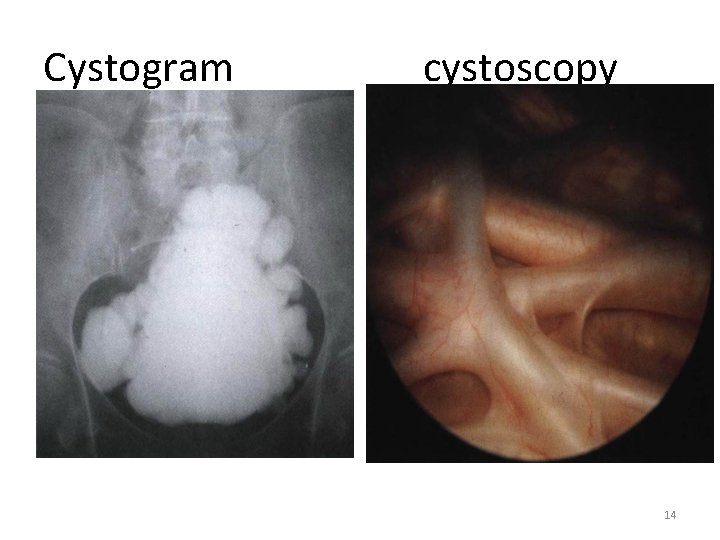 Cystogram cystoscopy 14 