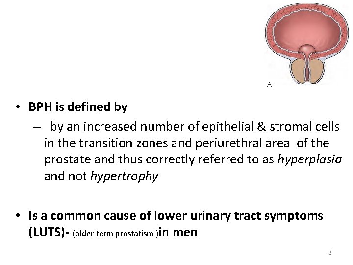  • BPH is defined by – by an increased number of epithelial &