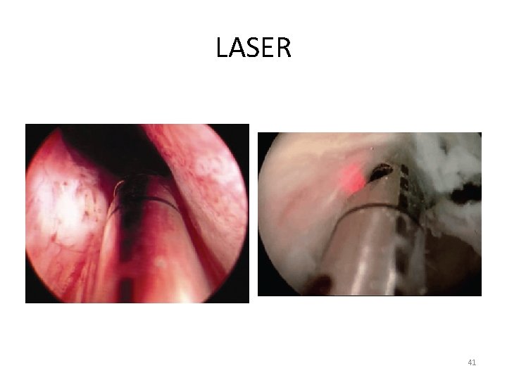 LASER 41 
