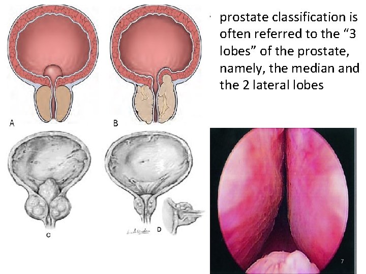  • prostate classification is often referred to the “ 3 lobes” of the
