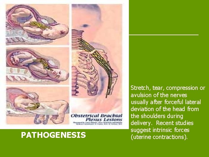 PATHOGENESIS Stretch, tear, compression or avulsion of the nerves usually after forceful lateral deviation