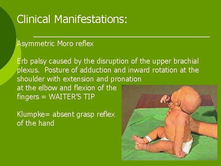 Clinical Manifestations: Asymmetric Moro reflex Erb palsy caused by the disruption of the upper