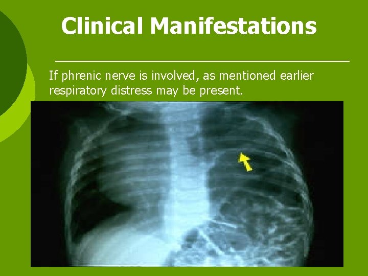 Clinical Manifestations If phrenic nerve is involved, as mentioned earlier respiratory distress may be