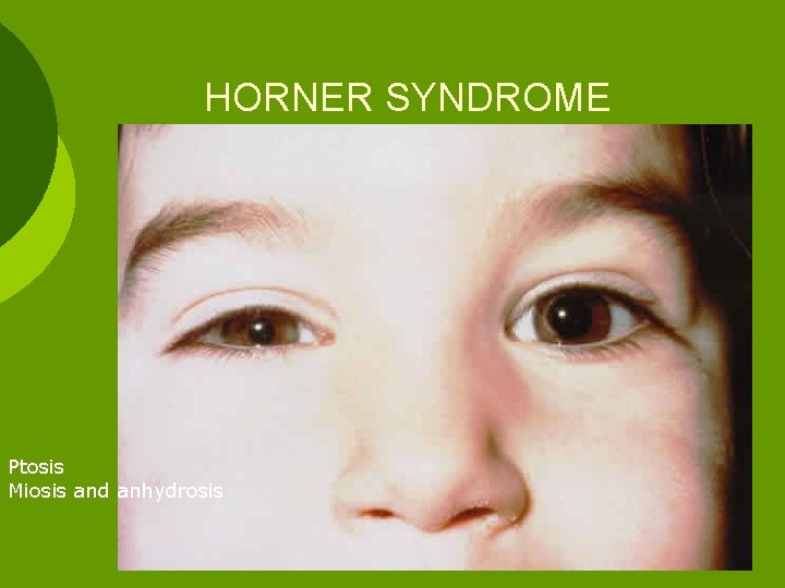 HORNER SYNDROME Ptosis Miosis and anhydrosis 