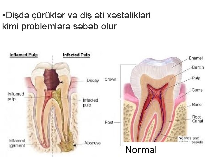  • Dişdə çürüklər və diş əti xəstəlikləri kimi problemlərə səbəb olur Normal 