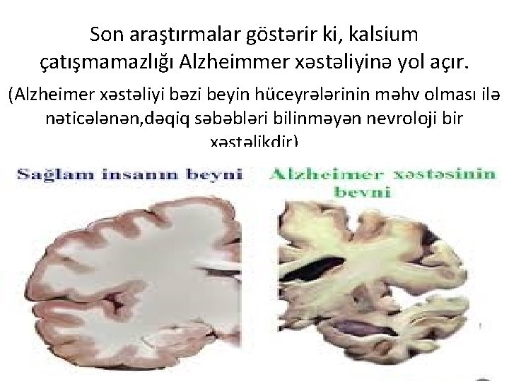 Son araştırmalar göstərir ki, kalsium çatışmamazlığı Alzheimmer xəstəliyinə yol açır. (Alzheimer xəstəliyi bəzi beyin